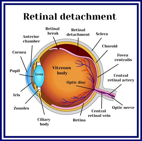 Retinal Tear & Detachment - Retina Vitreous Consultants, Inc