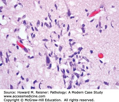 Pathology of the Nervous System | Basicmedical Key