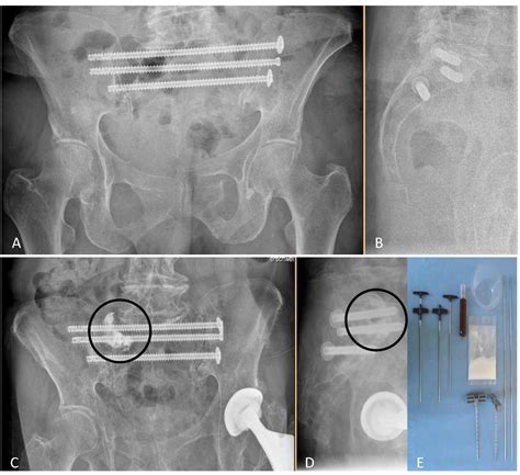 Figure 1 from Resource Consumption and Remuneration Aspects in Navigated Screw Fixation ...