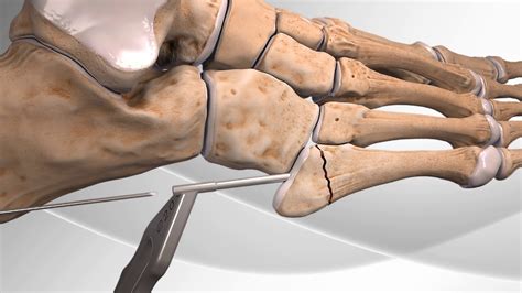 Pseudo Jones Fracture