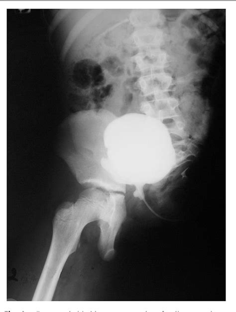 Figure 6 from Traumatic hemipelvectomy in children: report on 2 survivors with urological ...