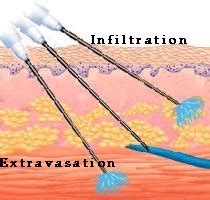 hematology - What happens if an IV drip with a saline solution slips ...