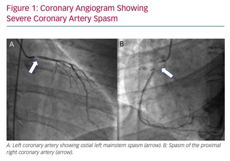 Coronary Angiogram Showing Severe Coronary Artery Spasm | ECR Journal