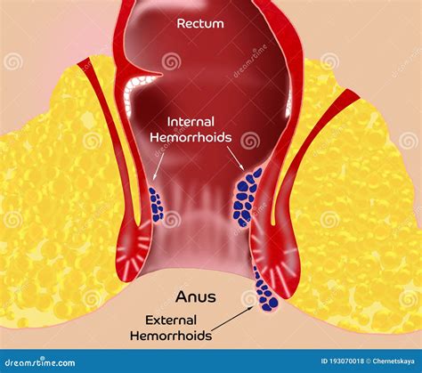 Hemorrhoid. Illustration Of Unhealthy Lower Rectum With Inflamed ...