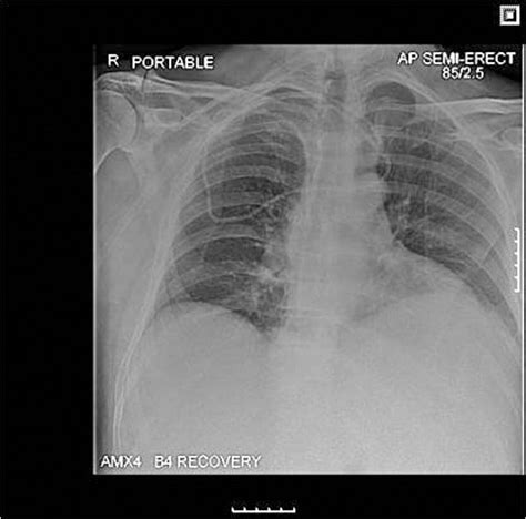 Spontaneous Hickman line migration | BMJ Case Reports