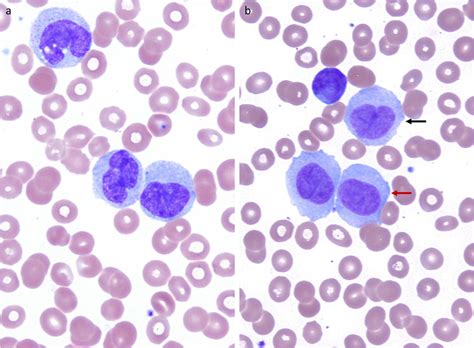 Abnormal monocytes and promonocytes. (a) Abnormal monocytes have... | Download Scientific Diagram