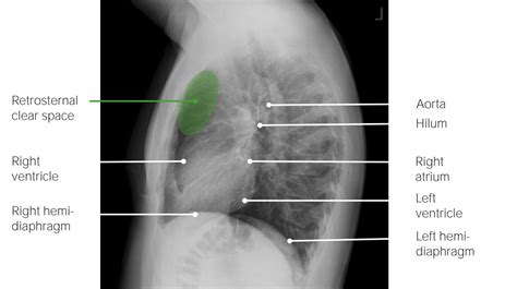 Pneumonia Lateral Chest X Ray