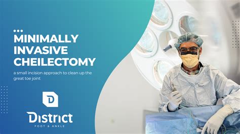 Minimally Invasive Joint Clean-Up – Cheilectomy Procedure | District Foot & Ankle