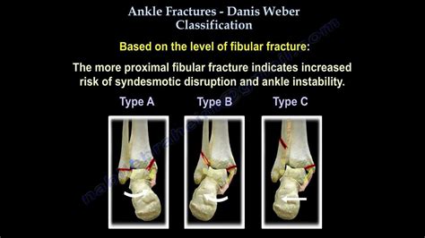 Ankle Fractures Danis Weber Classification - Everything You Need To Know - Dr. Nabil Ebraheim ...