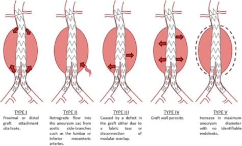 Endoleak classification system | Open-i