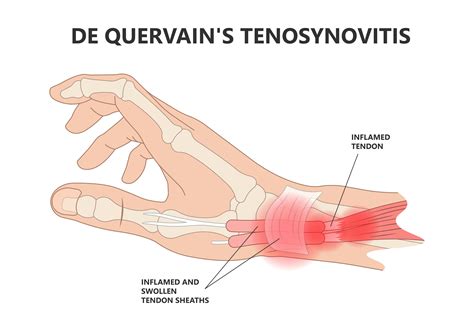 De Quervain’s Tenosynovitis - Dr Yaprak Plastic Surgeon