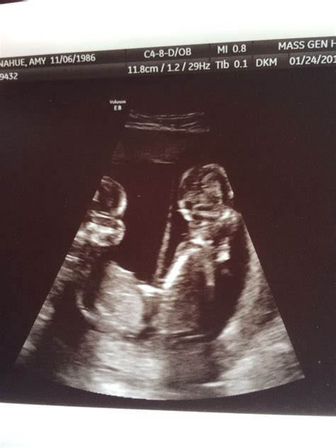 16 weeks ultrasound - Twiniversity