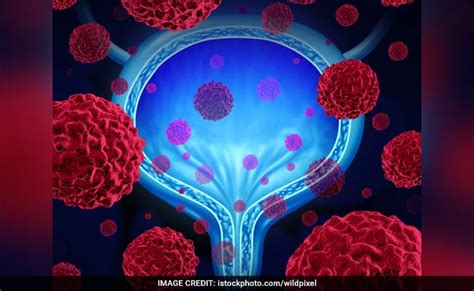 Blood In Urine May Indicate Prostate Cancer, 10 Early Signs Of Prostate Cancer