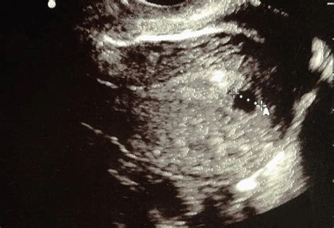 6 Weeks Pregnant Ultrasound: Procedure, Abnormalities & more