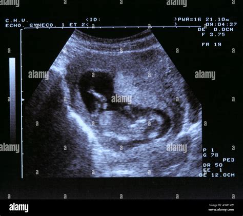 Fetal Ultrasound Image Gallery Fetal Pictures Of Ultrasound, 47% OFF