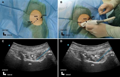 Preoperative pericapsular nerve group (PENG) block for total hip arthroplasty: a randomized ...