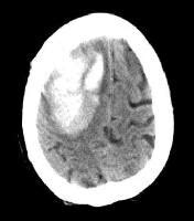 Intracranial Hemorrhage Workup