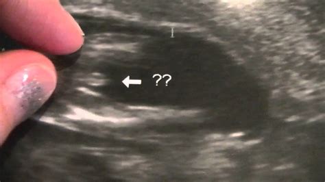 Ultrasound Proves Boy at 12 Weeks! - YouTube