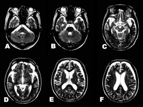 Brain T2-weighted imaging after neurological recovery. | Open-i