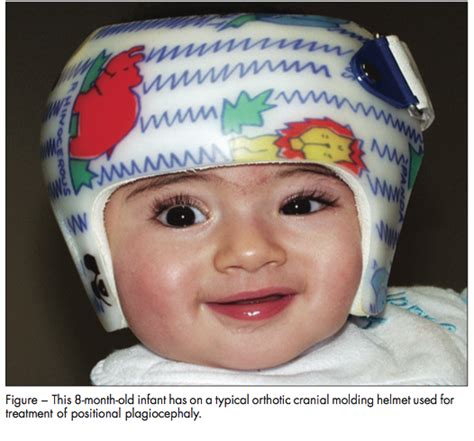 Positional Plagiocephaly, Part 2: Prevention and Treatment | Consultant360