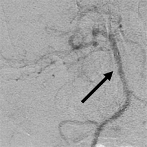 (A) MRI shows subacute infarct over right pons (arrow). (B) MRA shows ...