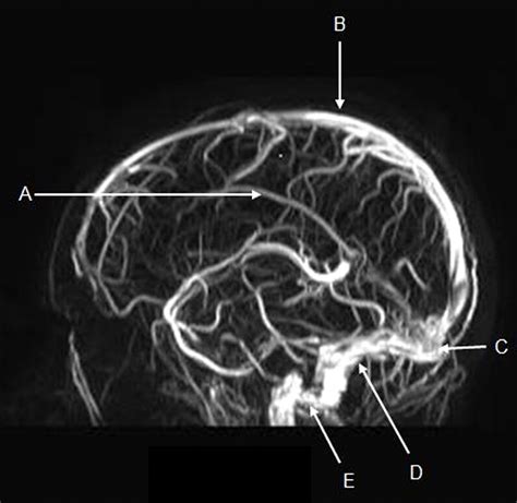 Anatomy of the dural venous sinuses | The BMJ