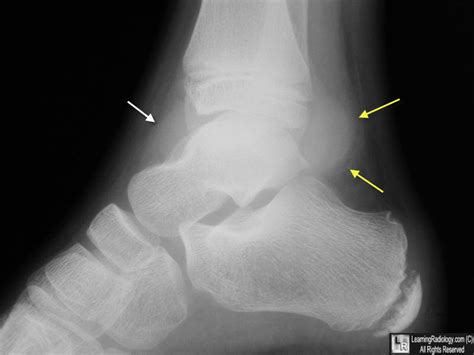 Learning Radiology - Ankle Joint Effusion