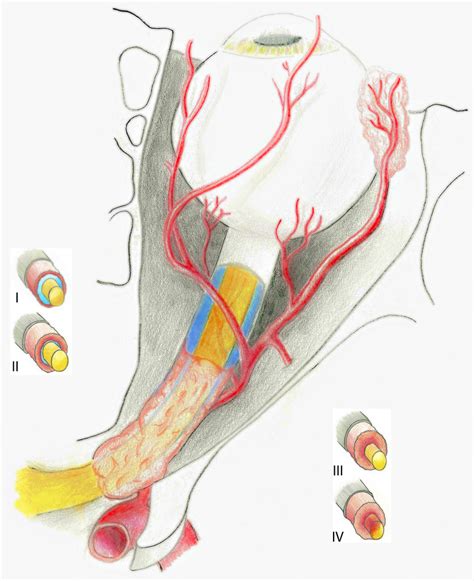 Prognostic factors in the surgical treatment of intracanalicular primary optic nerve sheath ...