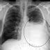 Nursing Diagnosis and Nursing Intervention for Atrial Septal Defect - Nursing Diagnosis ...