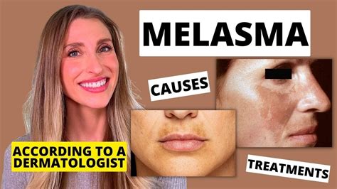 Melasma Melasma Treatment In Westerville, OH, 44% OFF