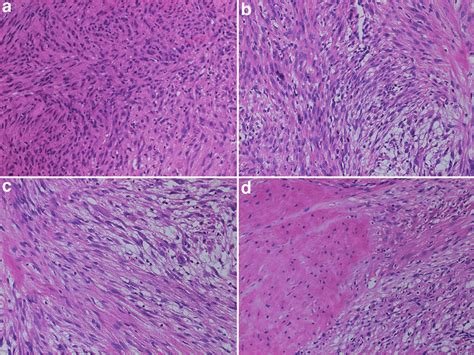 Histopathological features. (a) Epithelioid cells with abundant ...