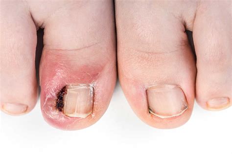 Ingrowing Toenail Treatment Farnham Surrey | Ingrowing Nail Assessment