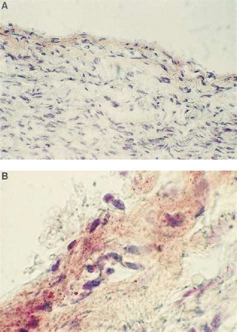 Figure 3 from Fatty streak formation occurs in human fetal aortas and is greatly enhanced by ...