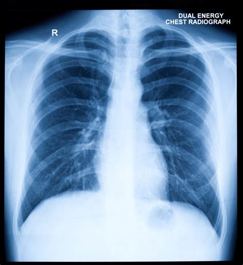 Chest X-Ray | Cardiovascular Medical Group of Southern California