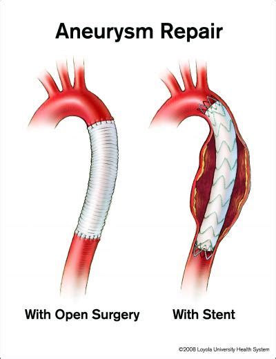 More aortic chest aneurysms being treated with less-invasive stents