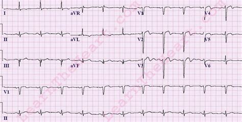 ECG Case #12 - Question #1 Answer | LearntheHeart.com