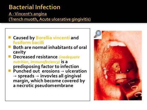 Vincent Angina Symptoms