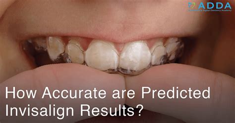 How Accurate are Predicted Invisalign Results? | Aesthetics & Digital ...