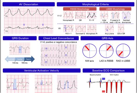 Ventricular Tachycardia Ecg