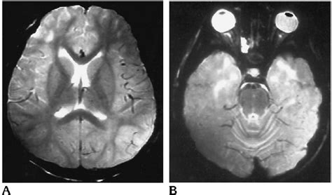 A 13-year-old boy with an 18- month history of SSPE, clinical stage ...