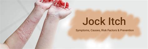 Jock Itch- Symptoms, Causes, Risk Factors and Prevention