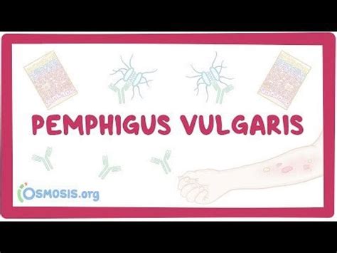 Pemphigus vulgaris : r/medicalvideotutorial