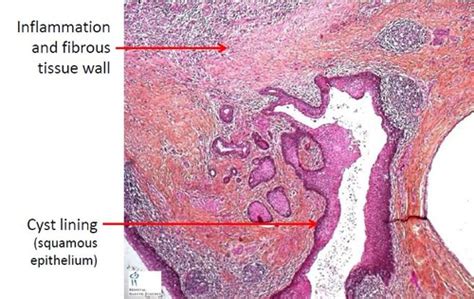 Thyroglossal Duct Cyst Histology