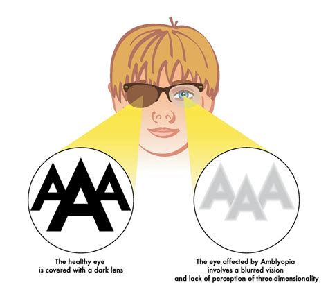 Amblyopia - Stereo Optical