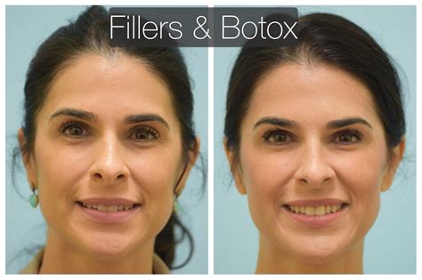 Botox Before And After Cheeks | Before And After