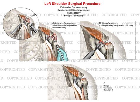 Left shoulder surgery - Synovectomy - Bursectomy - Debridement of RC t – Medical Art Works