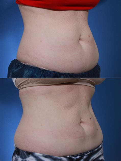 Coolsculpting Before and After Photos