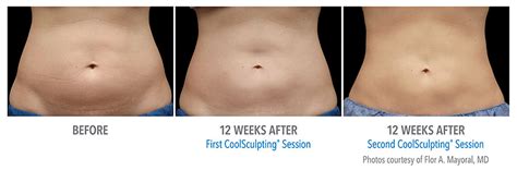 Coolsculpting | Novita Spa on the Square