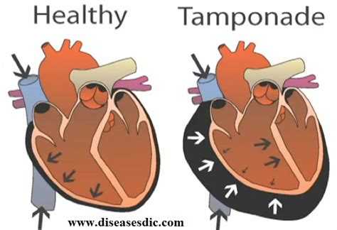 Cardiac Tamponade – Overview, Causes, and Diagnosis.