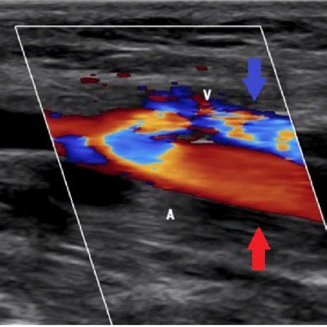 Duplex ultrasound demonstrating an arteriovenous fistula between the... | Download Scientific ...